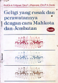 Geligi Yang Rusak dan Perawatannya Dengan Cara Mahkota dan Jembatan